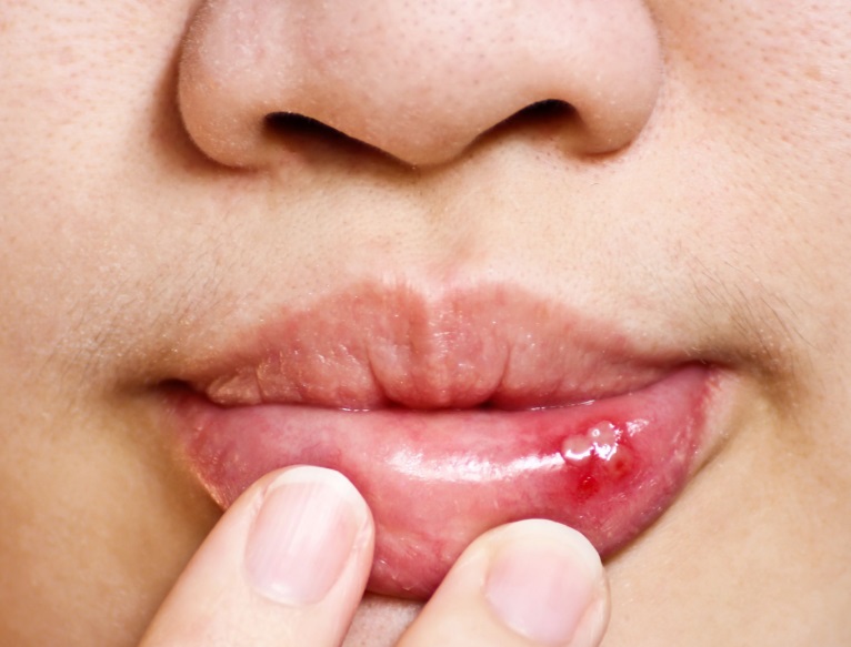 how-to-treat-a-blood-blister-in-the-mouth-learn-how-to